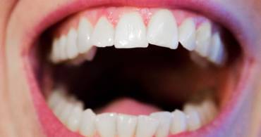 Bite per i denti: a cosa serve?