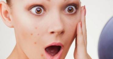 Stop all´acne controllando i livelli di vitamina B12